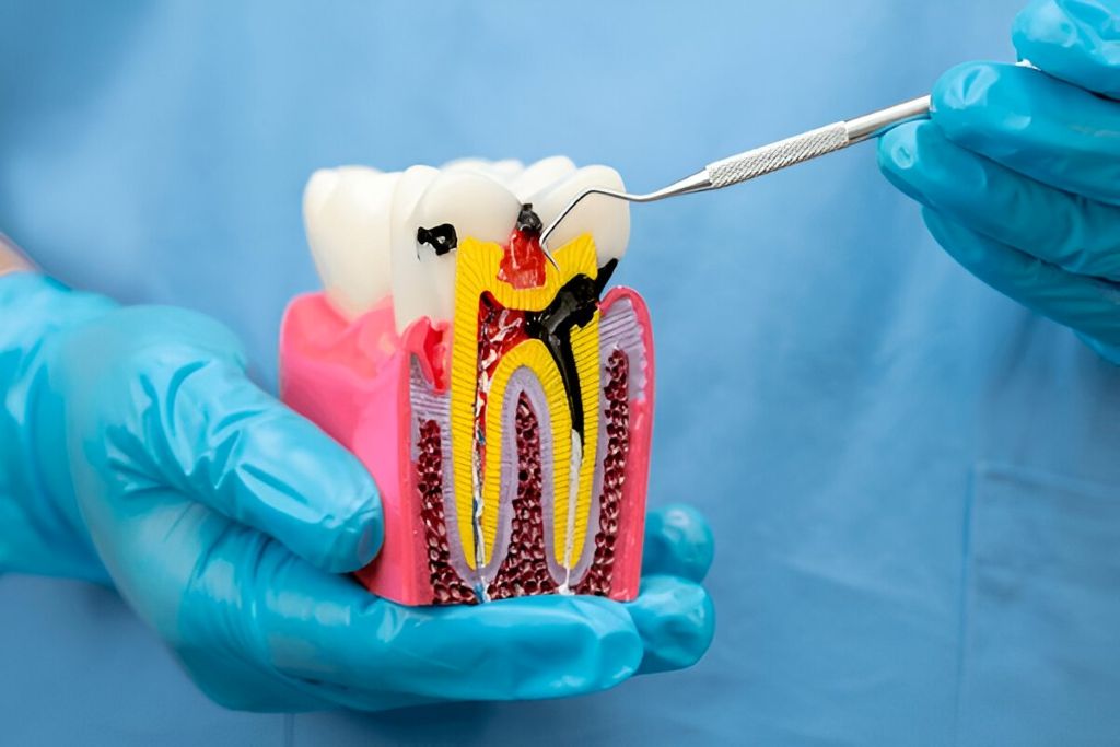 root canal therapy near you